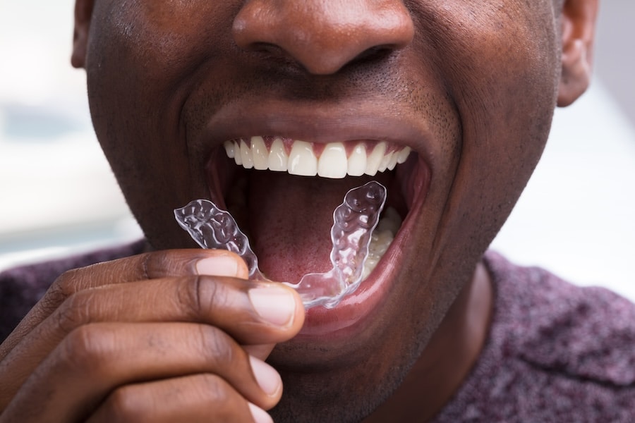 man with Invisalign aligners