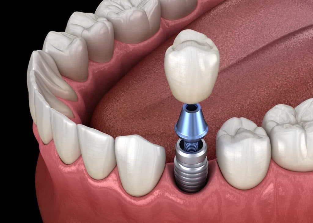 illustration of a dental implant